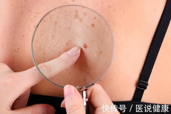 肝癌|肝病发生时,身体或反复出现这4种不适,留心观察,及时就医