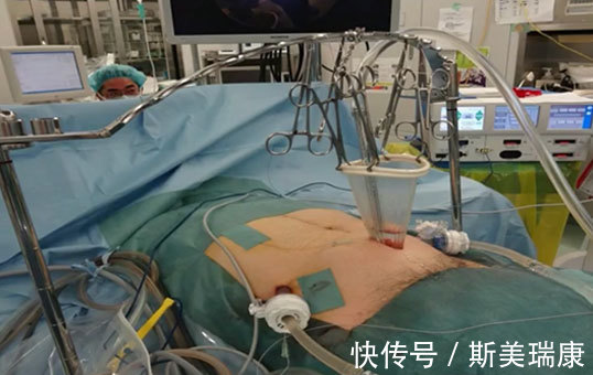 癌细胞|日本米村丰胃癌患者生存曲线:五年生存率达到47%!