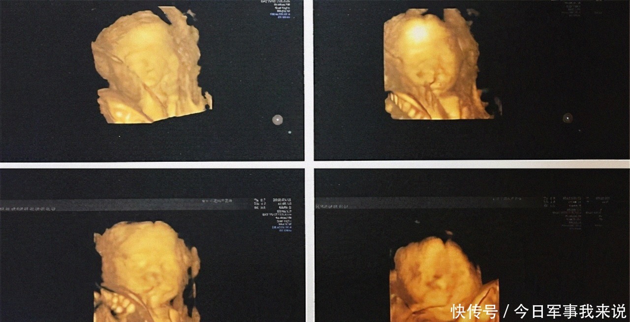 孩子|B超时胎儿“笑”得很灿烂,父母直夸宝宝可爱,医生:打掉孩子吧