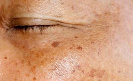 斑点|为什么大多数老年人都有“老年斑”牢记2个方法,你就不长斑