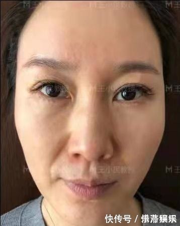 教授 拉皮除皱王小民教授:46岁的她选择了小拉皮手术,看看效果反馈!