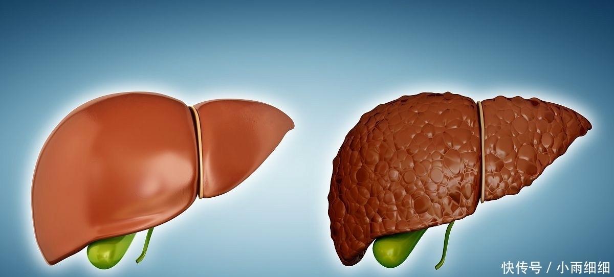 长期喝酒的人,三个检测能顺利通过,恭喜你暂时没有肝癌