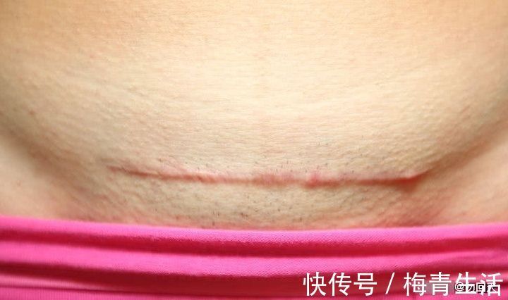 宝妈|剖腹产打麻药躲过疼痛,却留下3个后遗症,没中的宝妈相当幸运