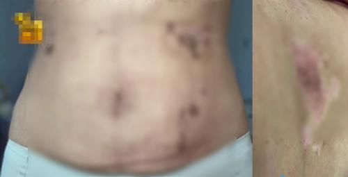 女子花近3万做抽脂手术，结果出现大面积淤青：老公都不敢碰我了