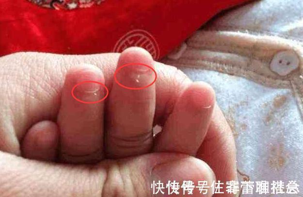 截肢|4岁小女孩手指长倒刺,奶奶举动使娃被迫截肢,医生怒斥无知