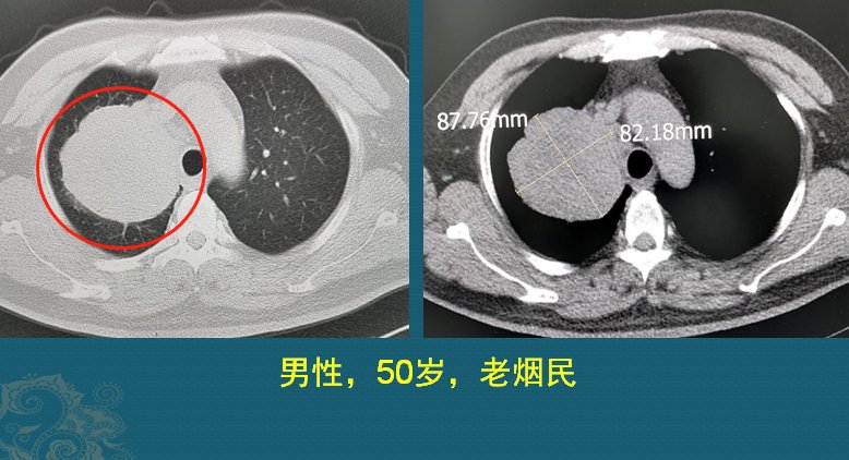 肺鳞癌|肺癌复发和转移的原因是什么？医生用2个病例，指导正确防癌