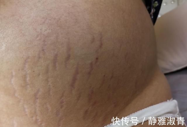 怀孕期间|怀孕后,不仅仅是肚子变大!还有这8种变化,你经历过几种?