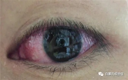 中医|自古中医就对白塞氏病有研究