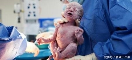 知识|剖腹产有风险!孕妈你知道这些知识吗?快点看看吧!