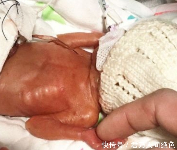 女子|女子生的孩子只有手掌大小,本以为活不久,半年过后,父母乐坏了