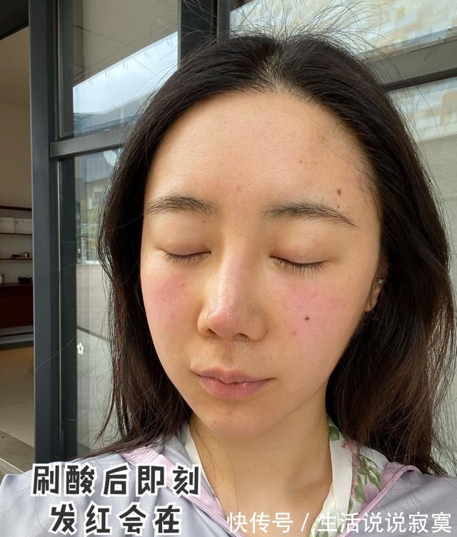 护肤品 果酸术后超全护理大全!