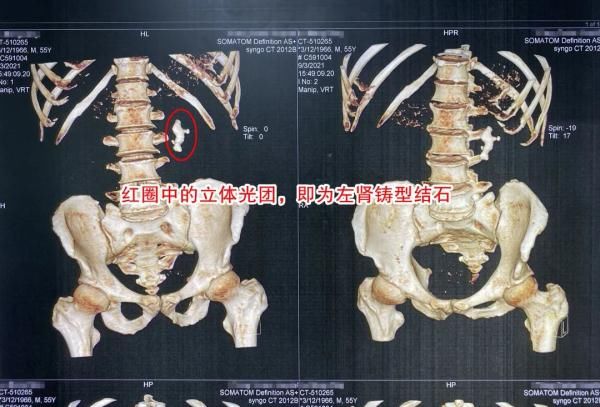 结石|男子常年痛风尿酸高，反复腰痛发现肾脏铸型结石危机