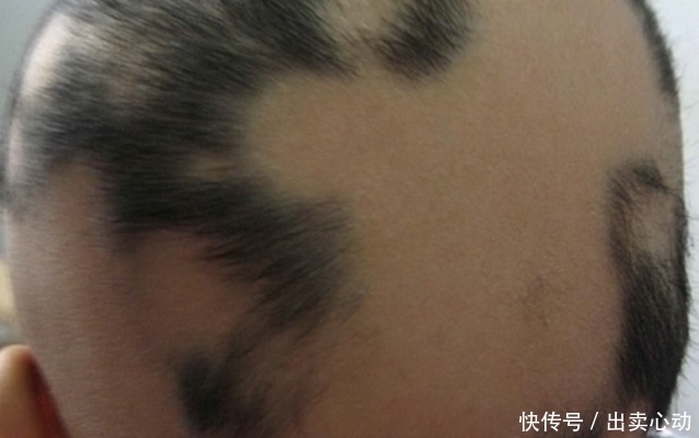 幼儿园|2岁孩子要补习5科,压力太大出现“鬼剃头”,医生见后异常惊讶