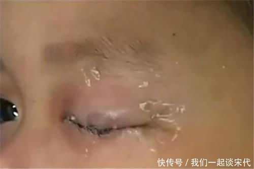 医生|4岁女儿误将胶水滴入眼睛,宝妈临危不乱的做法,医生直夸有文化