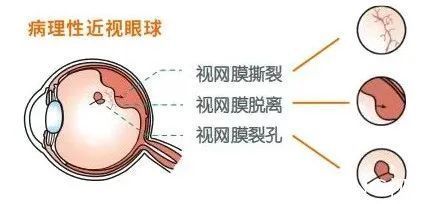 防范|权威提醒:近视度数不断增加或致盲,高度近视需引起重视和防范