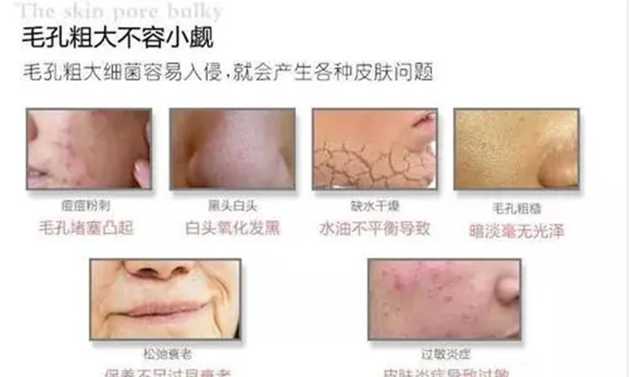回事|毛孔粗大别不当回事,这几个问题需要注意,避免形成“马蜂窝”