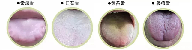 脾胃|珍贵舌诊:脾胃虚寒、胃阴不足、气滞血瘀的舌苔,看完记得存!
