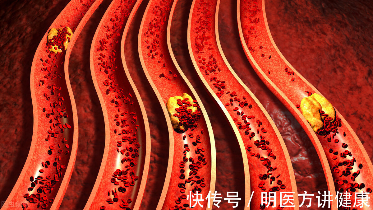 元凶|TA，才是糖尿病的主要元凶！明医方教你有效防范