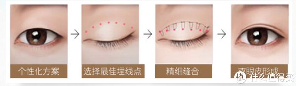 13年前做的双眼皮到现在还好吗？双眼皮带给我的变化