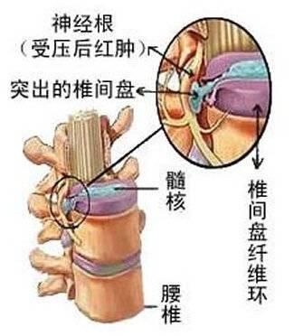  妙方|总是腰腿疼怎么办？一中医妙方医好上万人，腰间盘突出再也不来了