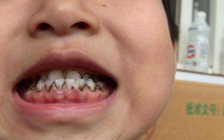 牙痛|6岁的孩子牙痛不见了，他被送到医院检查后，医生责备他的父母无知