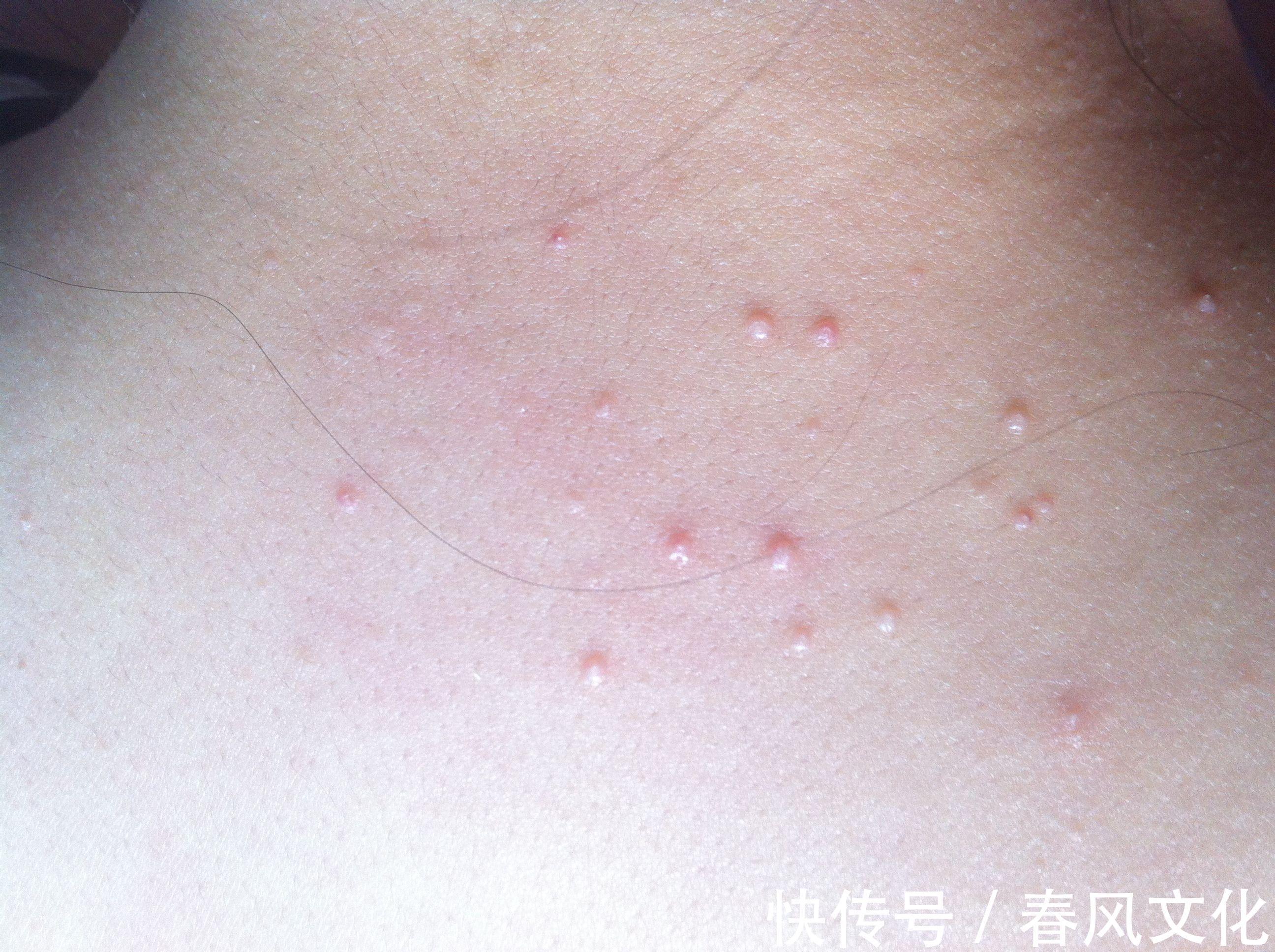 医生提示若是脖子上长了小肉球,最好是