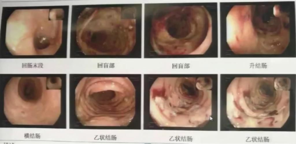 休克|反复便血十余天，一度出现失血性休克，原因竟然是……