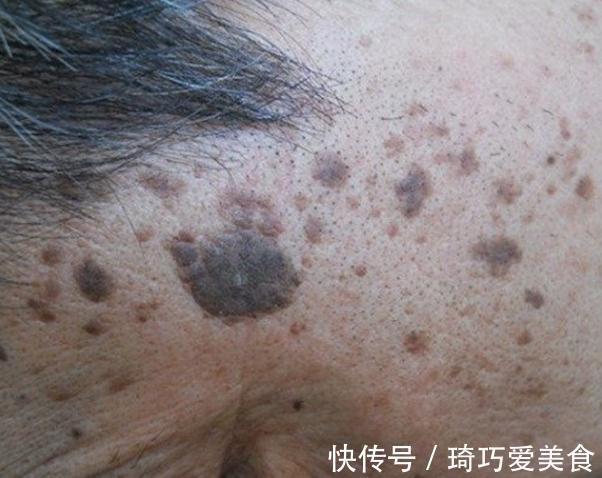 黑色素|老年斑除不掉怎么办?教你三个绝招,淡化老年斑,看上去更年轻