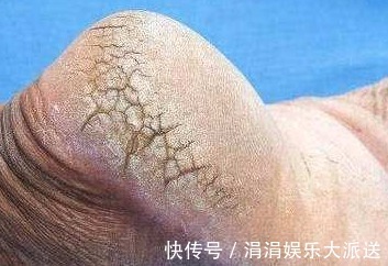 脚后跟|脚后跟的皮肤出现了干裂，不只是皮肤的问题，早知早受益