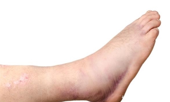 心血管疾病|不想血管越来越堵,教你4个方法,让血管垃圾自动消失!