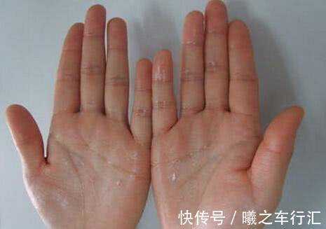 控压|血压高没高?手脚会告知!医生提醒:夏季控压做好三件事,别大意