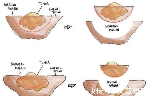 淋巴结|手术后癌症病人怎么知道肿瘤是不是切干净了？