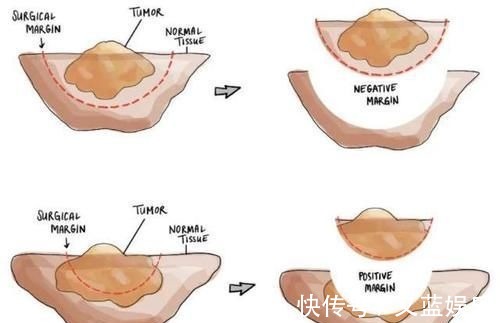 淋巴结|手术后癌症病人怎么知道肿瘤是不是切干净了?