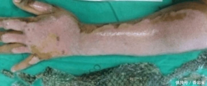 痊愈|女子全身被烧伤,医生植入“鱼皮”痊愈,网友:能美白吗?