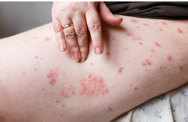 过敏|湿疹就是过敏引起的错，关于湿疹的5大谣言，不要再相信了