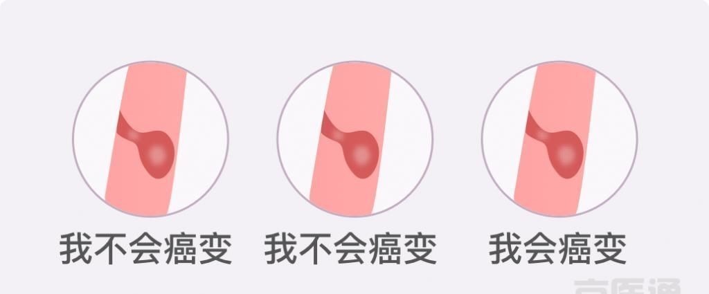 卵巢囊肿|结节、息肉、囊肿是癌症先兆吗?北肿专家们说出了真相!