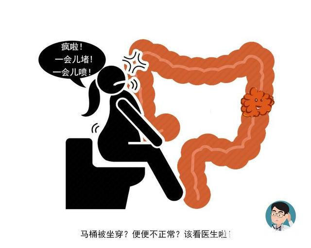 大便|早期的腸癌，癥狀很細微若排便出現這4個現象，那就要當心了