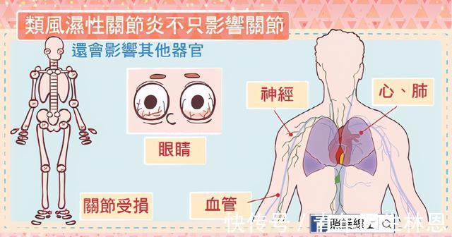 贫困|罹患“不死癌症”数十年,困扰张桂梅的这种疾病为何难以治愈?