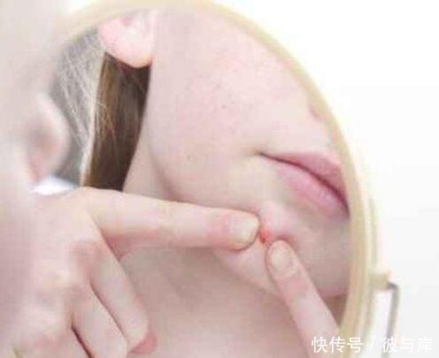 长痘留痘印,有几件事是诱因,但很多人还没有意识到!