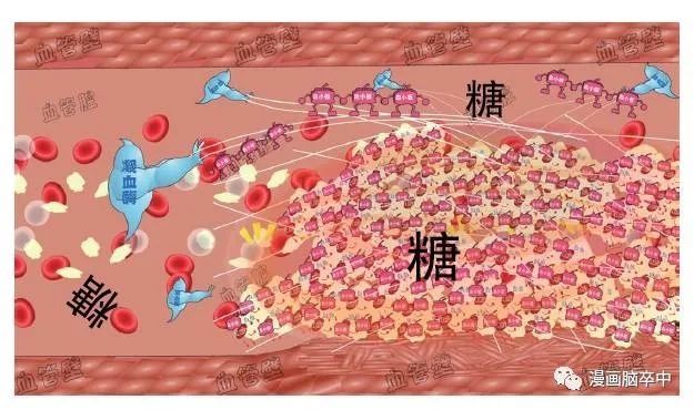 高血压|太形象！2分钟看懂脑卒中