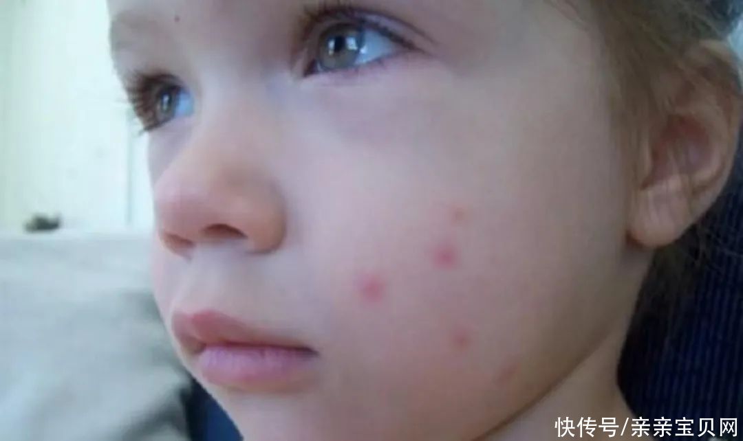 孩子|宝宝被蚊子叮咬可能会存在哪些“潜在危害”？看完宝宝少遭罪