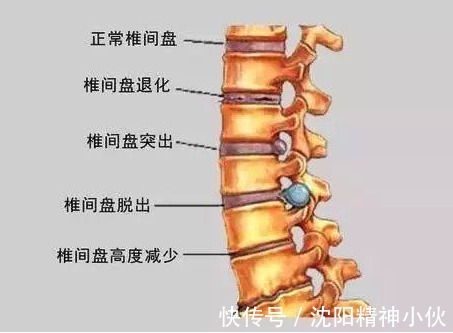 压迫|腰椎间盘突出症治不治？到底怎么治？听听医生怎么说！