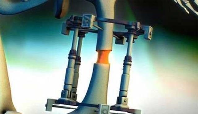 断骨|当年因矮身高自卑,花16万断骨增高7.2厘米的李亚诺,后来如何?