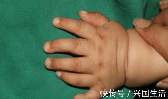 多指畸形|婴儿出生时有30多个手指医生看到了宝妈的手,明白了原因