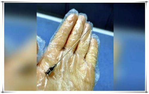 腰疼|宝妈剖腹产后总喊腰疼,看见剖腹产用的“针”,网友难怪了