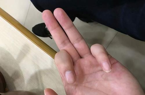 血糖|测血糖扎哪个手指最好？糖尿病协会告诉你，效果最准的3个手指