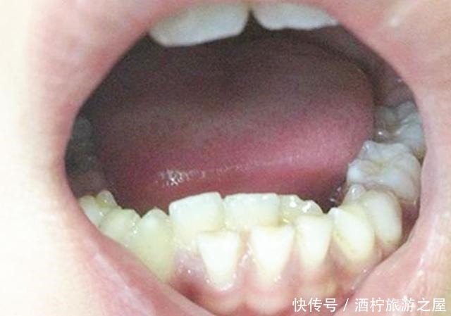 双排牙|7岁男孩乳牙未掉，恒牙又长，医生检查后说道幸亏来得及时