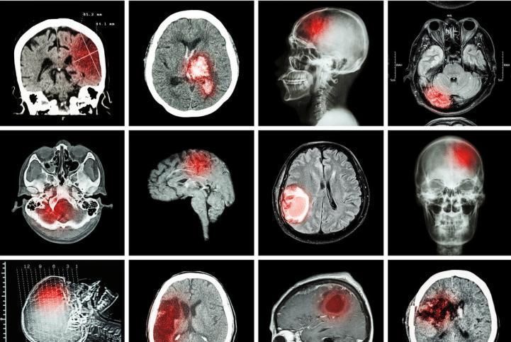 提醒大家：这3个信号一出现，或是脑梗要“上身