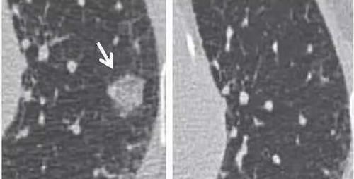 肺部|肺部磨玻璃结节8mm怎么办?如何判断良恶性?医生教你一招
