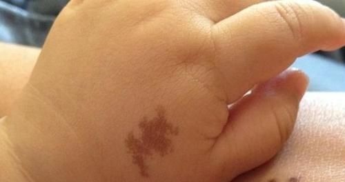 添加剂|不想宝宝出生后有胎记?孕期尽量避开三点,或许有助于胎儿发育